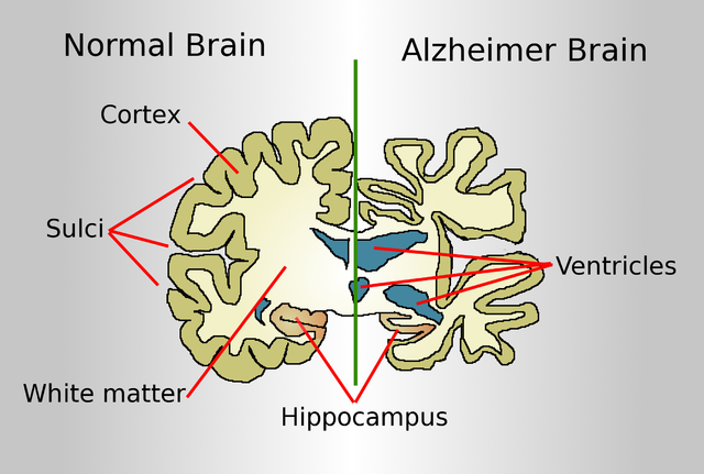 Vergleich eines gesunden und eines an Alzheimer erkrankten Gehirns.