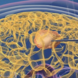 Magnetische Nanoteilchen werden direkt in den Tumor gespritzt